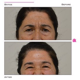 BOTOX - Forehead- Before and After