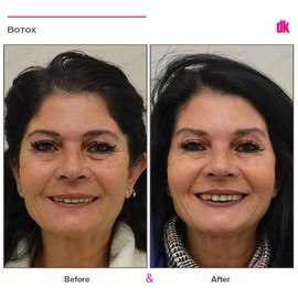 BOTOX - Forehead- Before and After