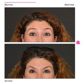 BOTOX - Forehead- Before and After