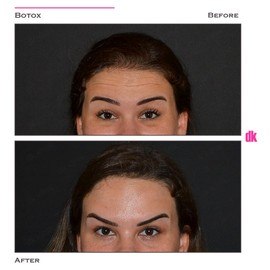 BOTOX - Forehead- Before and After