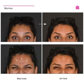 BOTOX - Forehead- Before and After