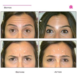 BOTOX - Frown Lines - Before and After