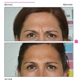 BOTOX - Frown Lines - Before and After