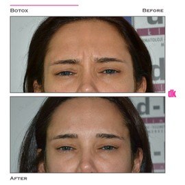 BOTOX - Frown Lines - Before and After