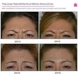 BOTOX - Frown Lines - Before and After
