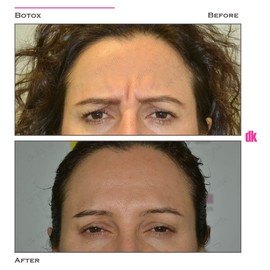 BOTOX - Frown Lines - Before and After
