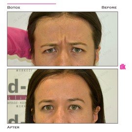 BOTOX - Frown Lines - Before and After