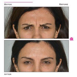 BOTOX - Frown Lines - Before and After