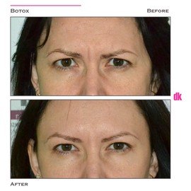 BOTOX - Frown Lines - Before and After