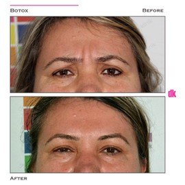 BOTOX - Frown Lines - Before and After