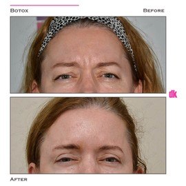 BOTOX - Frown Lines - Before and After