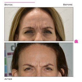 BOTOX - Frown Lines - Before and After
