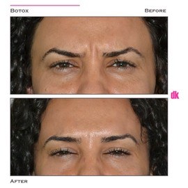 BOTOX - Frown Lines - Before and After