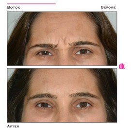 BOTOX - Frown Lines - Before and After