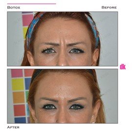 BOTOX - Frown Lines - Before and After