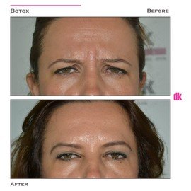 BOTOX - Frown Lines - Before and After