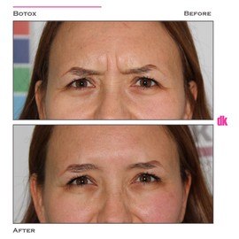 BOTOX - Frown Lines - Before and After