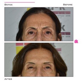 BOTOX - Frown Lines - Before and After