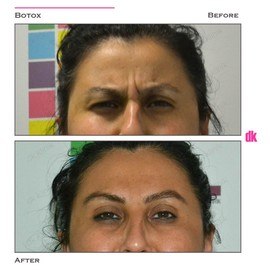BOTOX - Frown Lines - Before and After
