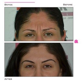 BOTOX - Frown Lines - Before and After