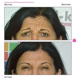 BOTOX - Frown Lines - Before and After