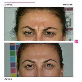 BOTOX - Frown Lines - Before and After