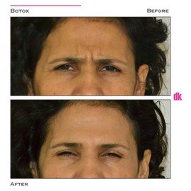 BOTOX - Frown Lines - Before and After