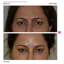 BOTOX - Frown Lines - Before and After
