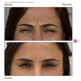 BOTOX - Frown Lines - Before and After