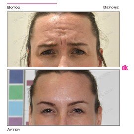 BOTOX - Frown Lines - Before and After