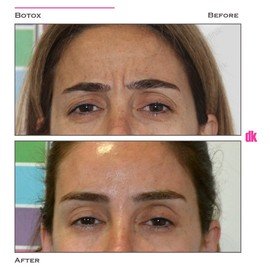 BOTOX - Frown Lines - Before and After