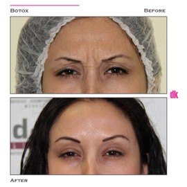 BOTOX - Frown Lines - Before and After