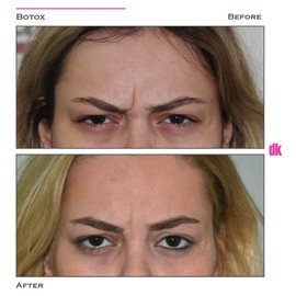 BOTOX - Frown Lines - Before and After