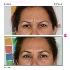 BOTOX - Frown Lines - Before and After