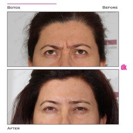 BOTOX - Frown Lines - Before and After