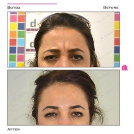 BOTOX - Frown Lines - Before and After
