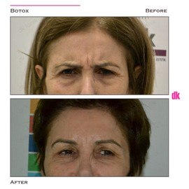 BOTOX - Frown Lines - Before and After