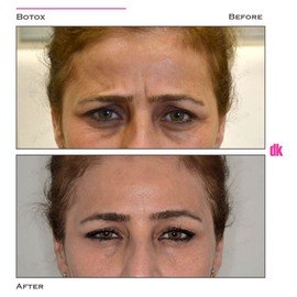 BOTOX - Frown Lines - Before and After