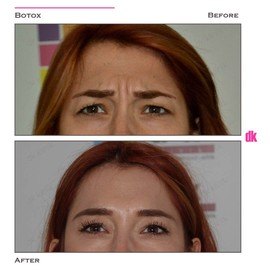 BOTOX - Frown Lines - Before and After
