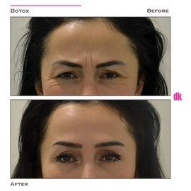 BOTOX - Frown Lines - Before and After