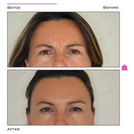 BOTOX - Frown Lines - Before and After