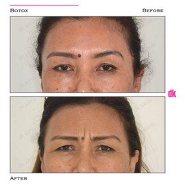 BOTOX - Frown Lines - Before and After