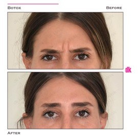 BOTOX - Frown Lines - Before and After