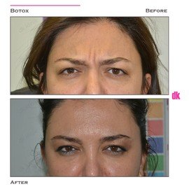 BOTOX - Frown Lines - Before and After