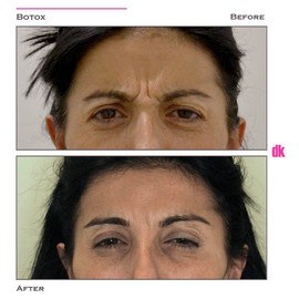 BOTOX - Frown Lines - Before and After