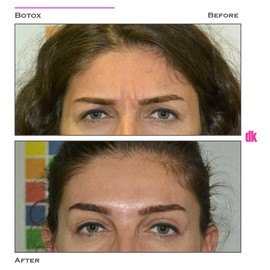 BOTOX - Frown Lines - Before and After
