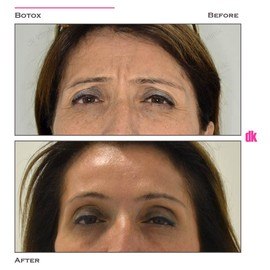 BOTOX - Frown Lines - Before and After