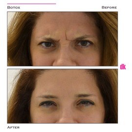 BOTOX - Frown Lines - Before and After