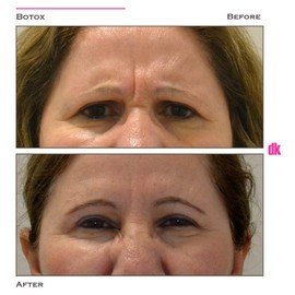 BOTOX - Frown Lines - Before and After