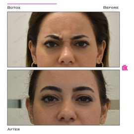 BOTOX - Frown Lines - Before and After